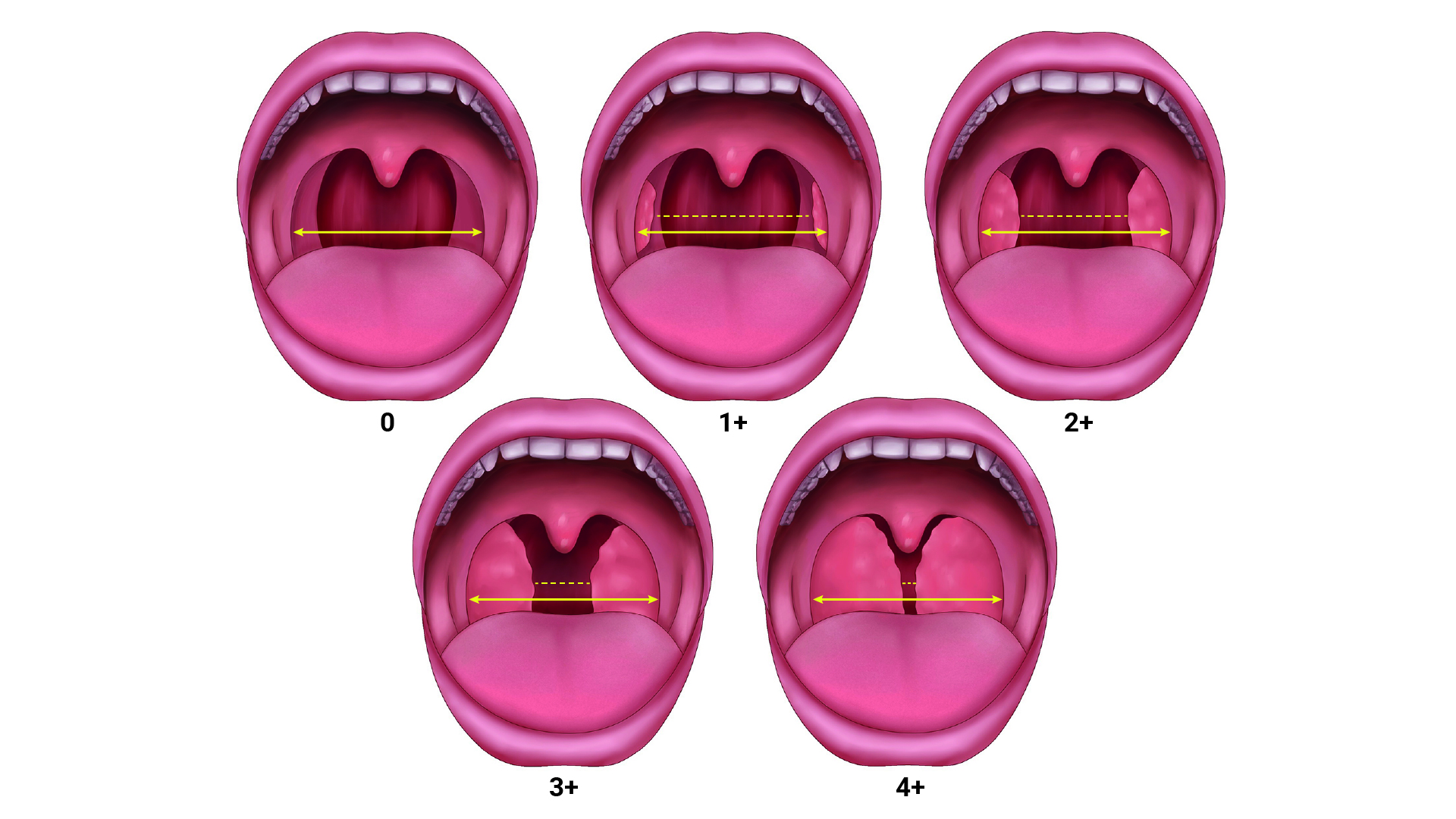 Pediatric Tonsillectomy And Adenoidectomy OpenAnesthesia