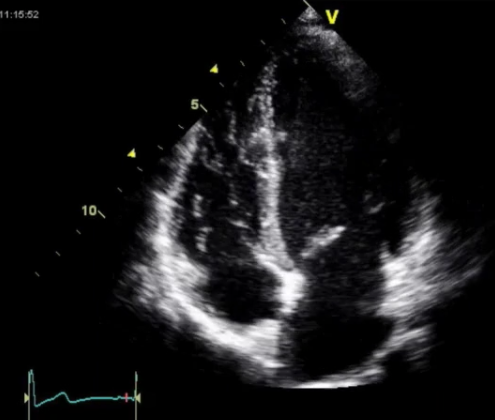 Focused Cardiac Ultrasound in Obstetric Anesthesia - OpenAnesthesia