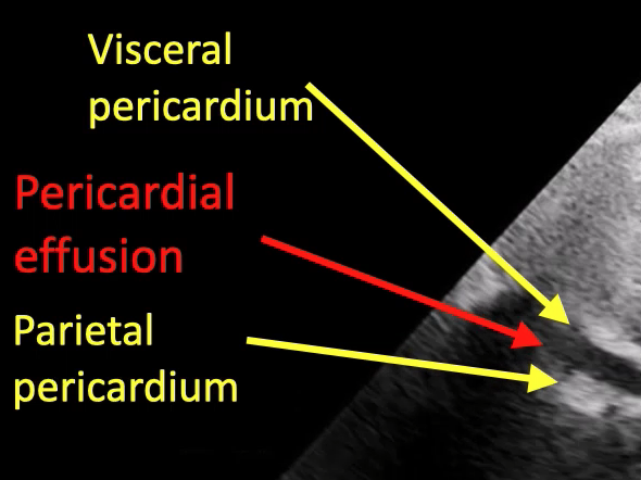 Point-of-Care Ultrasound Evaluation of Pericardial Effusion, Part 1 ...