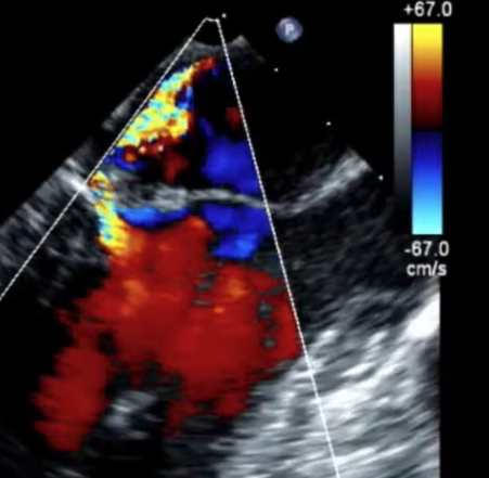 Mitral Valve Endocarditis - OpenAnesthesia