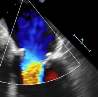 Mitral Regurgitation Measurement: Vena Contracta And Systolic Anterior 